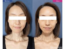 ユフラ(Juhla)/切らない小顔リフト