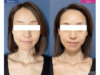 ユフラ(Juhla)/切らない小顔リフト