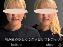 チョコバリ 恵比寿店(chocobari)/小顔リフトアップ（美容鍼）20代