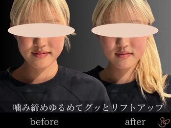 チョコバリ 恵比寿店(chocobari)/小顔リフトアップ（美容鍼）20代