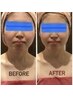 【最先端エイジングケア】BBLフェイシャル松◇より高い効果を実感したい方に