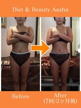 ダイエット アンド ビューティー アーシャ(Diet & Beauty Aasha)/ビーナスボディ施術例