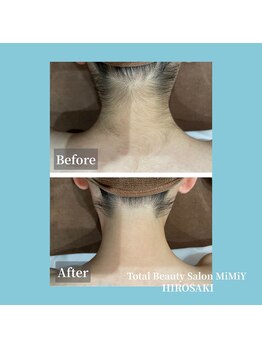 ミミー ヒロサキ(MiMiy HIROSAKI)/うなじ脱毛