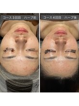 ロッタ エクリュ(Lotta ecru+)/REVI剥けないハーブピーリング