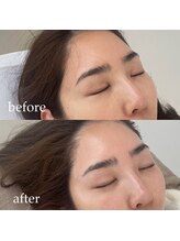 ナヴィ(NAVI)/【ララピール】水光ピーリング