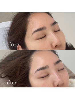 ナヴィ(NAVI)/【ララピール】水光ピーリング