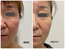 まろん鍼灸接骨院 立川店/美容鍼 &nbsp;Before→After！