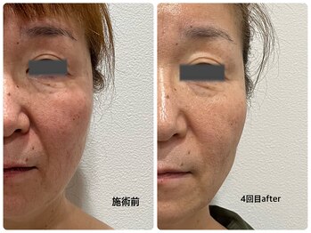 まろん鍼灸接骨院 立川店/美容鍼 &nbsp;Before→After！