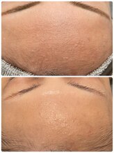 トリアングル(TLIENGLE)/ハーブピーリングbefore　after