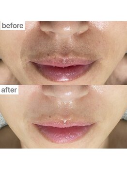 ユイット ルッカ(Huit Lucca)/ララピール×アクアダーマ