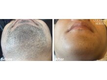 ラッシュ(RUSH)/8回で青ヒゲ卒業！