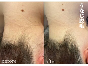 モノ(MONO)/【うなじ脱毛】