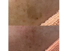 インディバ痩身サロン シュエット(Chouette)