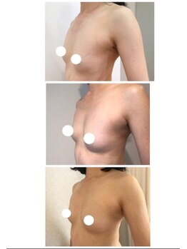 美人バスト 本厚木店/バストアップ◇症例◇