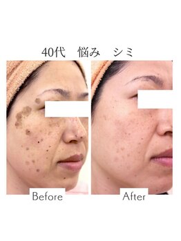 ファニービー 吹田店/40代 シミ 10ヶ月で改善