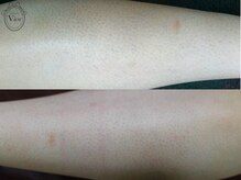 ヴィオール 名古屋栄店(VIOR)/【レデイース脱毛】　ひざ下