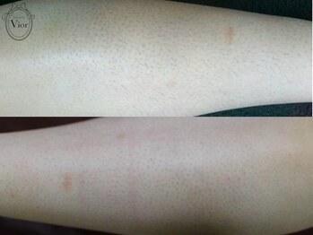 ヴィオール 名古屋栄店(VIOR)/【レデイース脱毛】 ひざ下