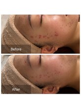 ラペ(la paix)/フェイス症例/1回目→3回目