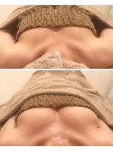 リール 新宿店(RIRE)/30代後半　バストアップ症例