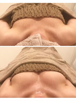 リール 新宿店(RIRE)/30代後半 バストアップ症例