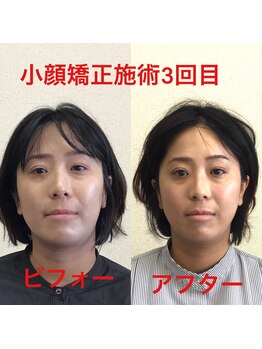 オズ六本木/六本木小顔矯正(造顔)施術3回