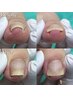 オススメ♪【巻き爪・陥入爪補正２か所】￥11000