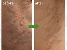 メルシア(merucia)/詰まり、ニキビケア、肌質改善