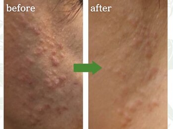 メルシア(merucia)/詰まり、ニキビケア、肌質改善