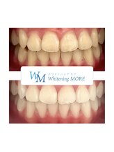 ホワイトニング モア(Whitening MORE)/ビフォーアフター
