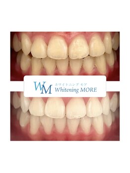 ホワイトニング モア(Whitening MORE)/ビフォーアフター