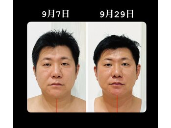 真美(Sinbi)/リターンフェイシャル/施術2回