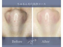 サロンドボーテアリス (Salon de beaute ALICE)/黒ずみ除去で透明感UP