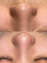 韓国肌管理室ハナ(hana)/肌質改善/毛穴洗浄/毛穴洗浄大阪