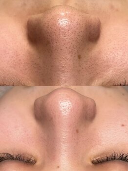 韓国肌管理室ハナ(hana)/肌質改善/毛穴洗浄/毛穴洗浄大阪