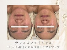 アネラボーテ(Anela Beaute)/ラフォスフェイシャル1回目