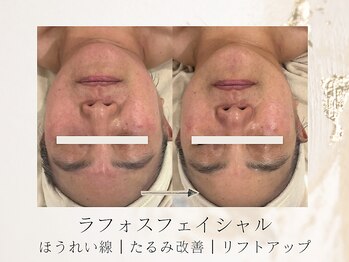 アネラボーテ(Anela Beaute)/ラフォスフェイシャル1回目