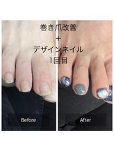 巻き爪改善+デザインネイル