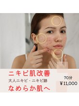 ミモザ(mimosa)/ニキビ肌改善◎繰返す大人ニキビ