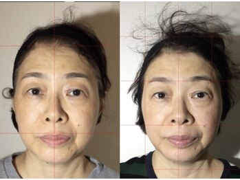 整体サロン プラスエル 東向島(Plus L)/小顔★ビフォーアフター