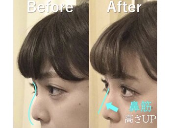 ラプリ 横浜店(Raplit)/隆鼻+輪郭矯正40分