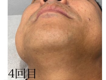 ラヴィエール(Laviere)/【メンズ脱毛】お顔(ヒゲこみ)