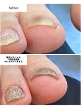 ケアプラス(care plus)/巻爪ケアジェル+シェラック