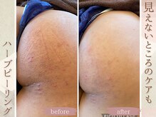 ラナ(LaNa)/お尻ハーブピーリング