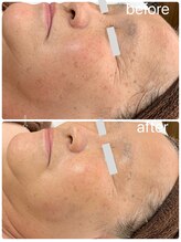 月とルーツ 大阪南堀江(月とroots)/鼻筋の皺.目元シワ.目の疲れ