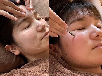 スパチャーレ(Spa ciare)の写真/塗る小顔矯正＆ハリケア♪【刺さない美容針＋漢方美容★60分￥6600】速攻引き締め、リフトアップ！