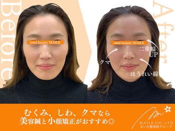 マイレ 甲賀水口店(MAILE)/美容鍼(30代女性/施術1回目)