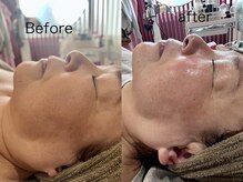 ラローゼ トウキョウ(LA ROSEE TOKYO)/顎ライン、ほうれい線　スッキリ