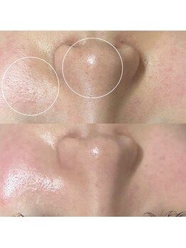 パールフェイスエステ ルペルル(PEARL FACE ESTHE la perle)/毛穴ケアでツルツルお肌に