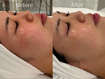 リフコウベ(LIF KOBE)/アンストレスで赤ら顔卒業♪