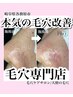 【毛穴リピーター限定】毛穴エクストラクションプロ♪モニター価格11,000円→